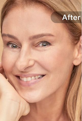 Wrinkles after