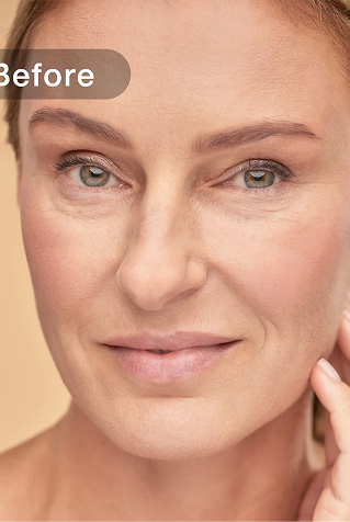 Wrinkles before